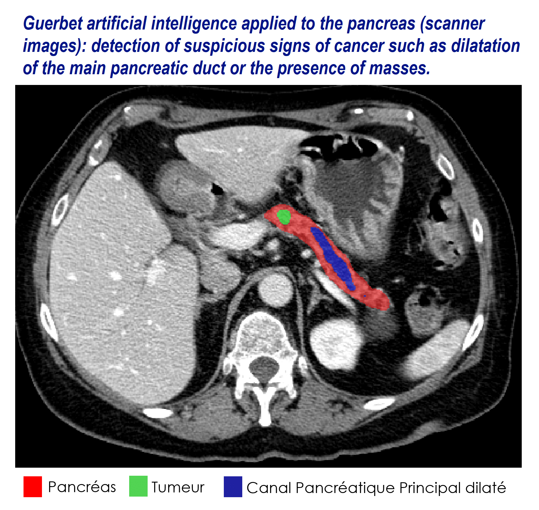 Guerbet artificial intelligence applied to the pancreas (scanner images): detection of suspicious signs of cancer such as dilatation of the main pancreatic duct or the presence of masses.