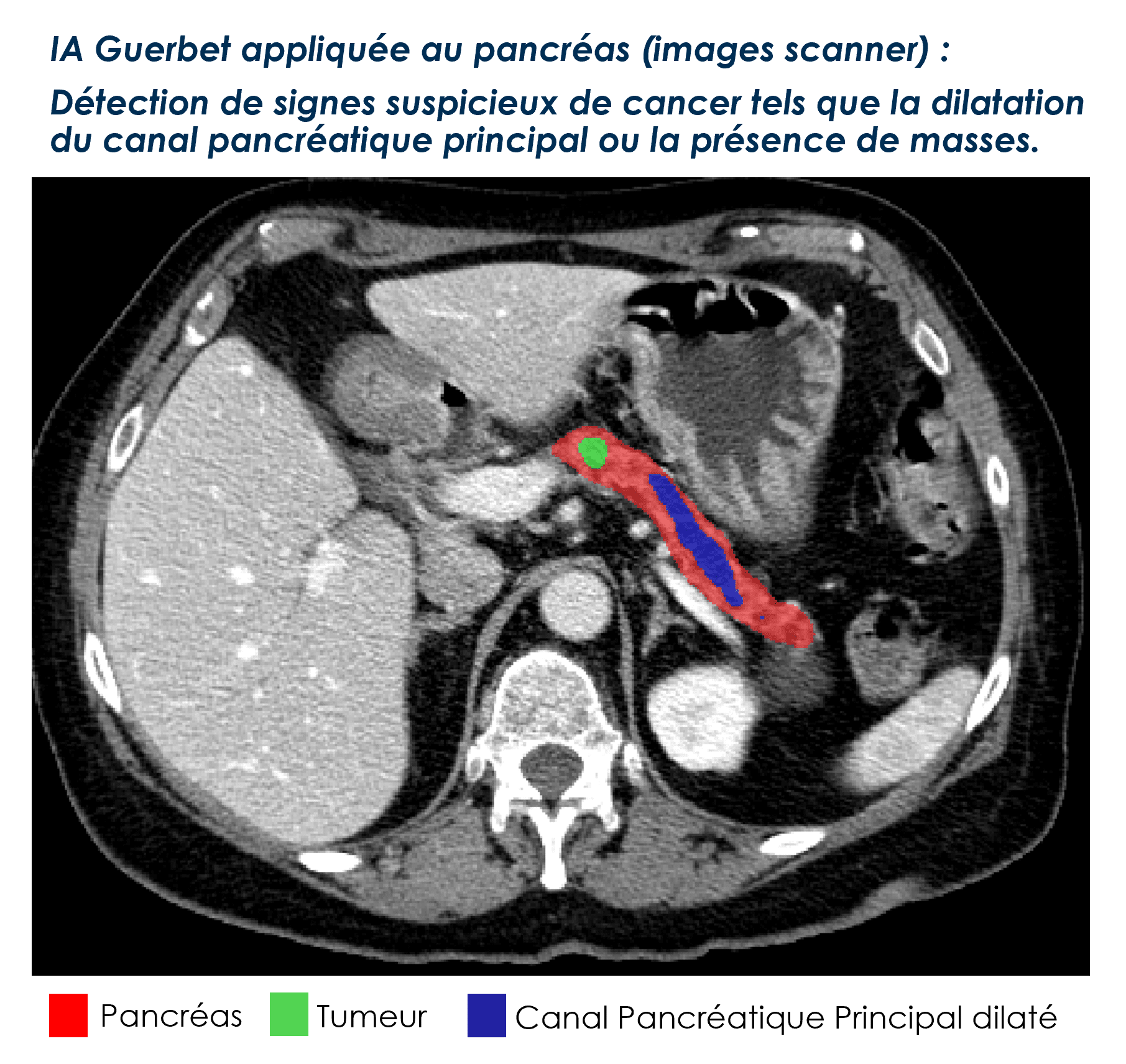 IA Guerbet appliquée au pancréas (images scanner) : Détection de signes suspicieux de cancer tels que la dilatation du canal pancréatique principal ou la présence de masses.