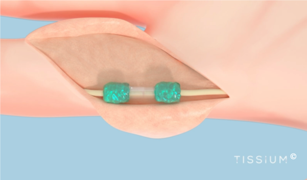 tissium : tissue reconstruction